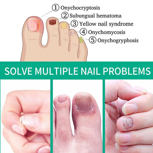 Sérum de traitement des ongles pour l'onychomycose, l'atrophie et la surface irrégulière, pour restaurer la douceur et la brillance des ongles SUN N.