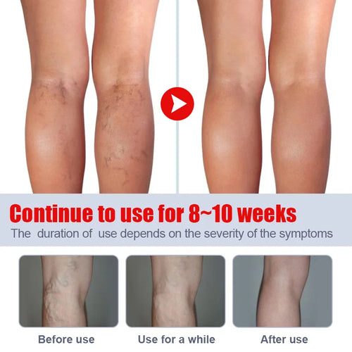 Crème de traitement des varices, soulage la hernie veineuse, améliore la vascularite, la phlébite, les soins des veines d'araignée, favorise la circulation sanguine SUN N.