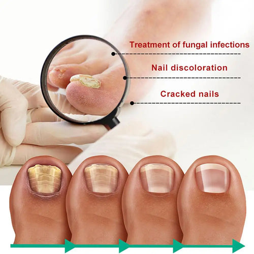 Sérum de traitement des ongles pour l'onychomycose, l'atrophie et la surface irrégulière, pour restaurer la douceur et la brillance des ongles SUN N.