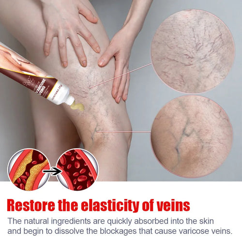 Crème de traitement des varices, soulage la hernie veineuse, améliore la vascularite, la phlébite, les soins des veines d'araignée, favorise la circulation sanguine SUN N.