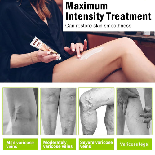 Crème de traitement des varices, soulage la hernie veineuse, améliore la vascularite, la phlébite, les soins des veines d'araignée, favorise la circulation sanguine SUN N.